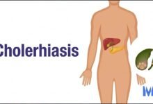 Cholerhiasis