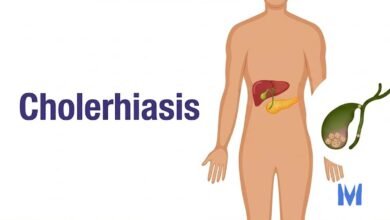 Cholerhiasis
