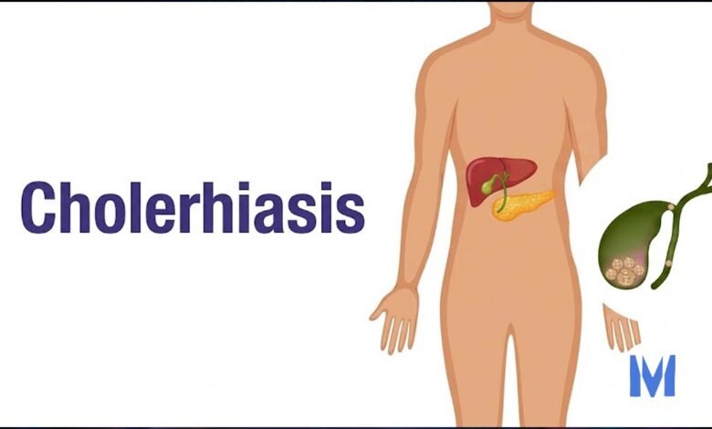 Cholerhiasis